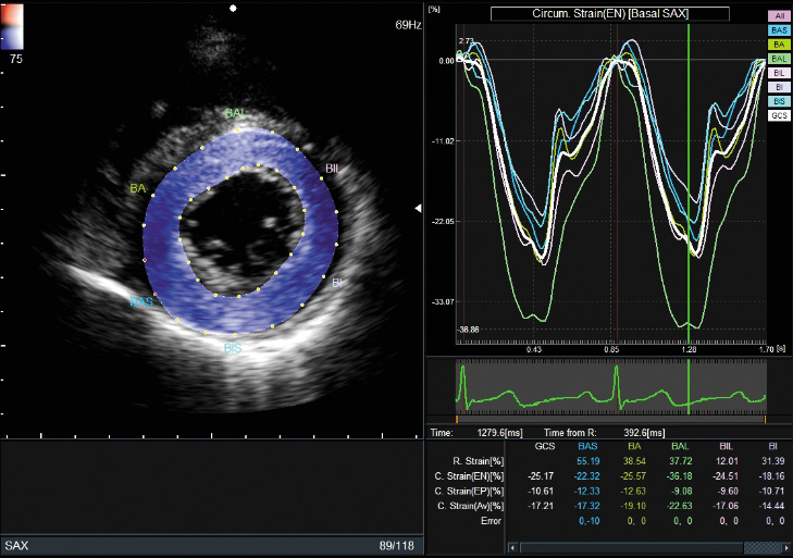 Анализ в режиме слежения за структурами сердца 2D Tissue Tracking