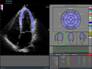 Анализ в режиме слежения за структурами сердца 2D Tissue Tracking<br />