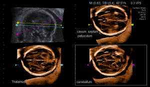 Проекции головного мозга плода в режиме Curved MPR (CMPR)