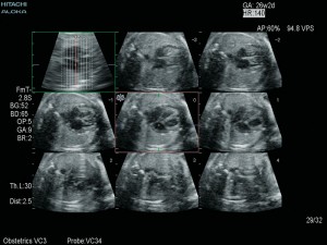 Объёмное сканирование сердца плода<br />