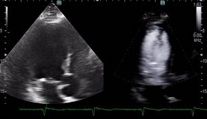 Виртуальное контрастирование левого желудочка сердца<br />