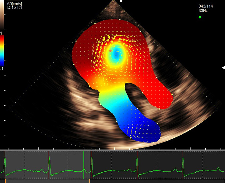 Отображение карты относительного давления с помощью VFM в случае дилатационной кардиомиопатии